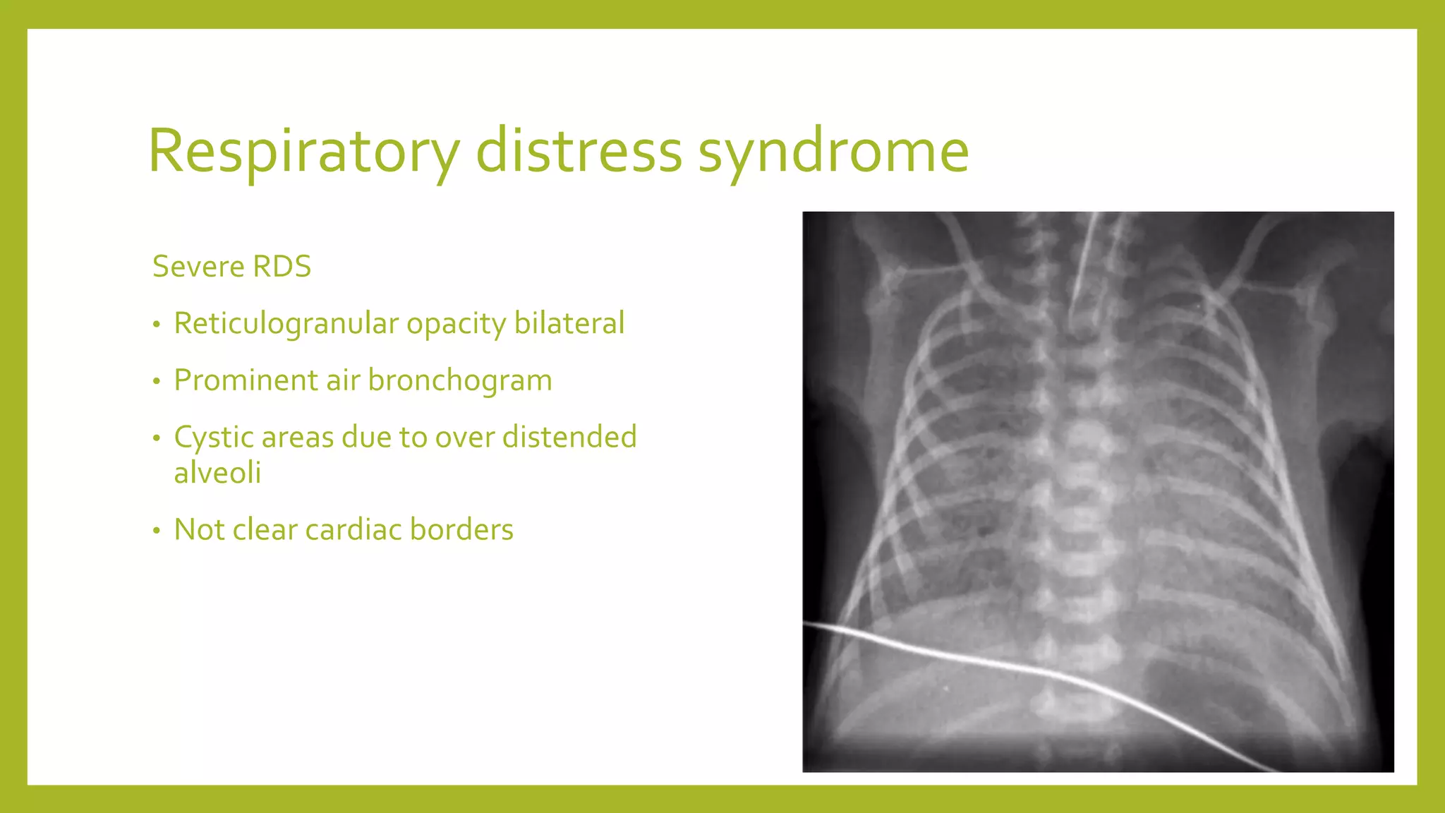 Respiratory distress syndrome
Severe RDS
• Reticulogranular opacity bilateral
• Prominent air bronchogram
• Cystic areas due to over distended
alveoli
• Not clear cardiac borders
 