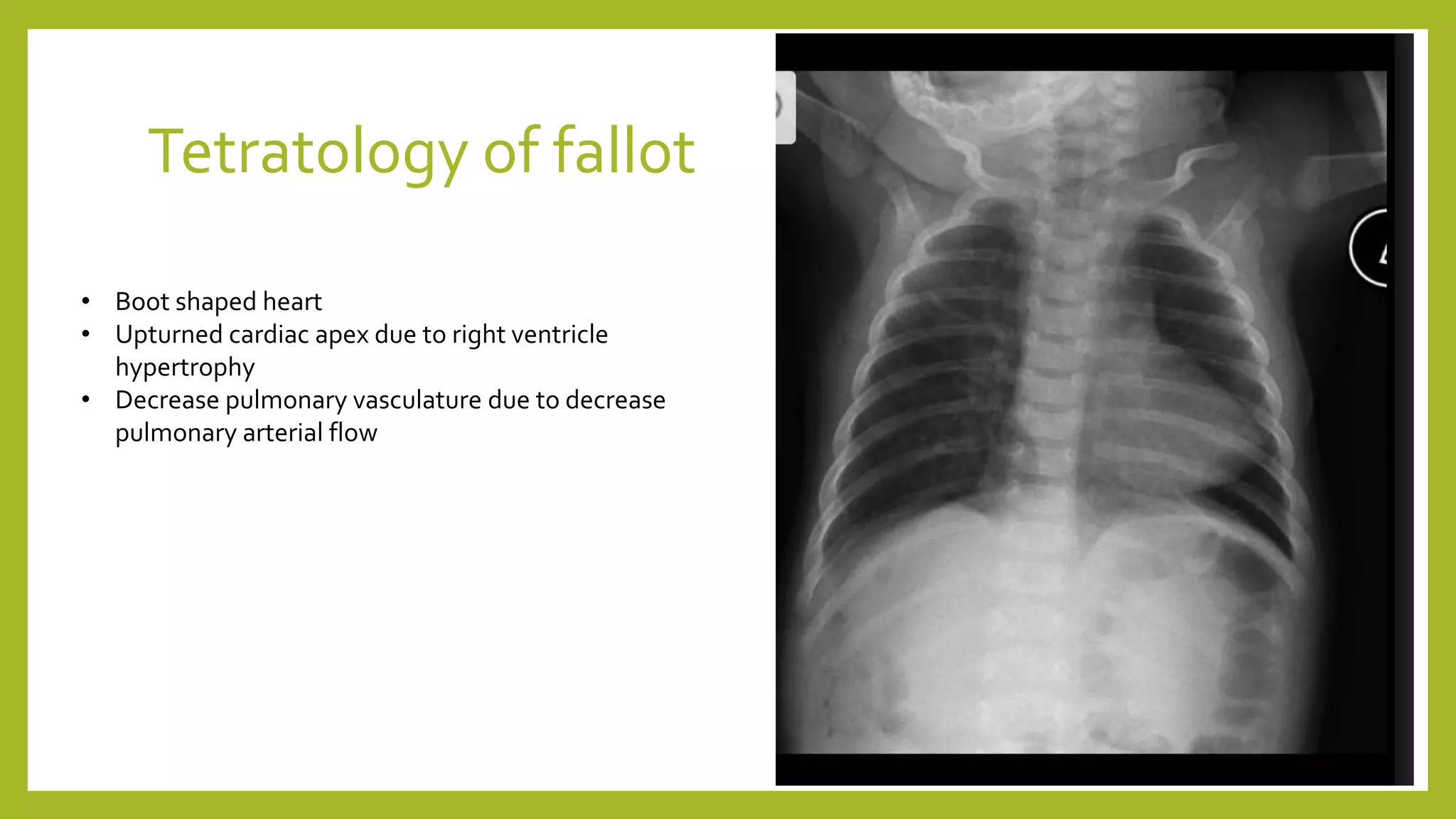 Tetratology of fallot
• Boot shaped heart
• Upturned cardiac apex due to right ventricle
hypertrophy
• Decrease pulmonary vasculature due to decrease
pulmonary arterial flow
 