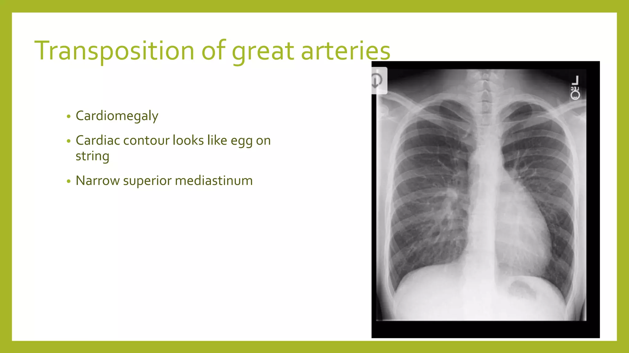 Transposition of great arteries
• Cardiomegaly
• Cardiac contour looks like egg on
string
• Narrow superior mediastinum
 