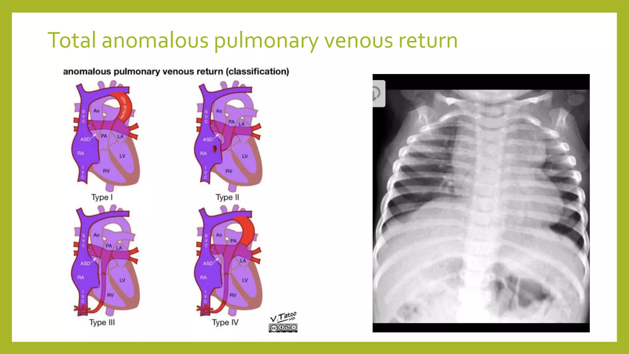 Total anomalous pulmonary venous return
 