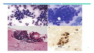 Approach to cytopathology diagnosis of soft tissue tmors.pptx