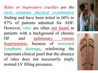 Rales or inspiratory crackles are the
most common physical examination
finding and have been noted in 66% to
87% of patients admitted for AHF.
However, rales are often not heard in
patients with a background of chronic
HF and pulmonary venous
hypertension, because of increased
lymphatic drainage, reinforcing the
important clinical pearl that the absence
of rales does not necessarily imply
normal LV filling pressures.
 