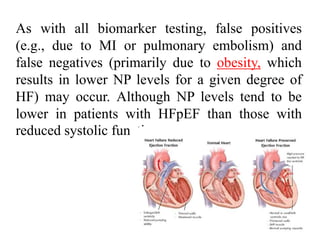 As with all biomarker testing, false positives
(e.g., due to MI or pulmonary embolism) and
false negatives (primarily due to obesity, which
results in lower NP levels for a given degree of
HF) may occur. Although NP levels tend to be
lower in patients with HFpEF than those with
reduced systolic function,
 