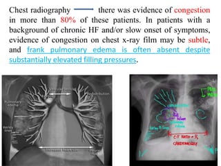 Chest radiography there was evidence of congestion
in more than 80% of these patients. In patients with a
background of chronic HF and/or slow onset of symptoms,
evidence of congestion on chest x-ray film may be subtle,
and frank pulmonary edema is often absent despite
substantially elevated filling pressures.
 