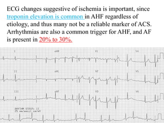 ECG changes suggestive of ischemia is important, since
troponin elevation is common in AHF regardless of
etiology, and thus many not be a reliable marker of ACS.
Arrhythmias are also a common trigger for AHF, and AF
is present in 20% to 30%.
 