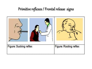 Releace Sign Approach to dementia | PPTX