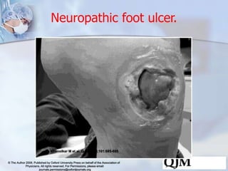 Neuropathic foot ulcer. 
Khanolkar M et al. QJM 2008;101:685-695 
© The Author 2008. Published by Oxford University Press ...