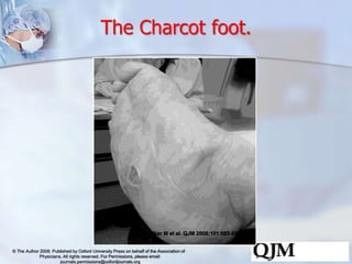 The Charcot foot. 
Khanolkar M et al. QJM 2008;101:685-695 
© The Author 2008. Published by Oxford University Press on beh...
