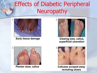Effects of Diabetic Peripheral 
Neuropathy 
 