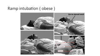 Effective Ramp Intubation APPROACH TO DIFFICULT AIRWAY2222222.pptx