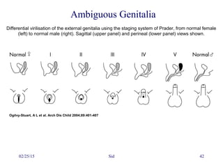02/25/15 Sid 42
Ogilvy-Stuart, A L et al. Arch Dis Child 2004;89:401-407
Differential virilisation of the external genitalia using the staging system of Prader, from normal female
(left) to normal male (right). Sagittal (upper panel) and perineal (lower panel) views shown.
Ambiguous Genitalia
 