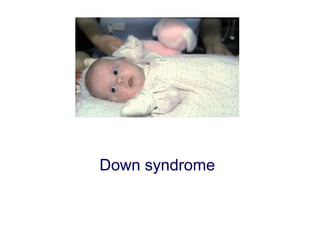 Down syndrome
 