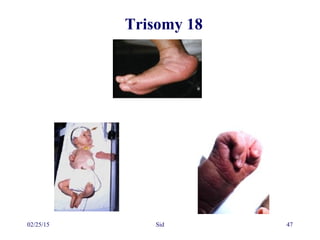 02/25/15 Sid 47
Trisomy 18
 