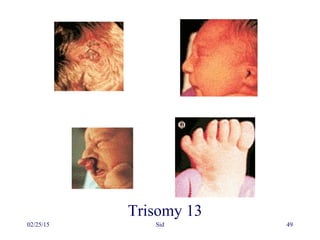 02/25/15 Sid 49
Trisomy 13
 