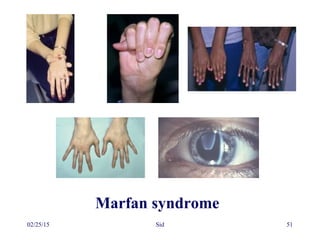 02/25/15 Sid 51
Marfan syndrome
 