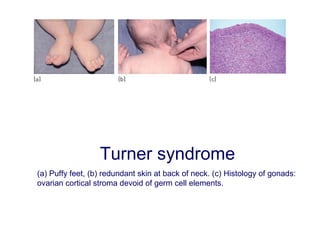 Turner syndrome
(a) Puffy feet, (b) redundant skin at back of neck. (c) Histology of gonads:
ovarian cortical stroma devoid of germ cell elements.
 