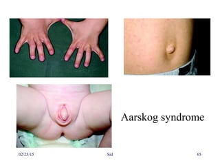 02/25/15 Sid 65
Aarskog syndrome
 