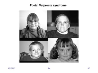 02/25/15 Sid 67
Foetal Valproate syndrome
 