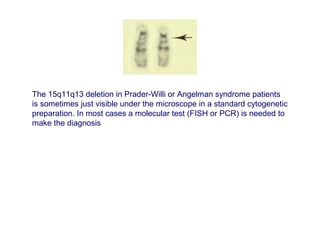 The 15q11q13 deletion in Prader-Willi or Angelman syndrome patients
is sometimes just visible under the microscope in a standard cytogenetic
preparation. In most cases a molecular test (FISH or PCR) is needed to
make the diagnosis
 