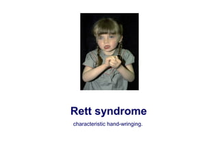 Rett syndrome
characteristic hand-wringing.
 