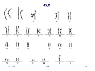 02/25/15 Sid 77
45,X
 