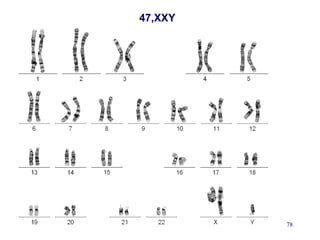 02/25/15 Sid 78
47,XXY
 