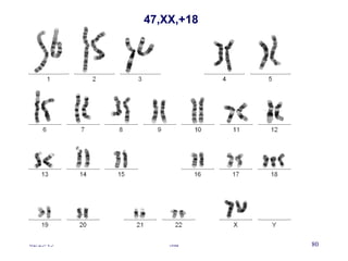 02/25/15 Sid 80
47,XX,+18
 