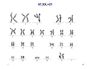 02/25/15 Sid 81
47,XX,+21
 