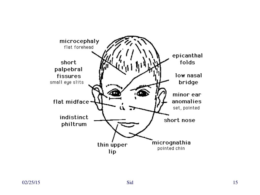 Approach to dysmorphic child