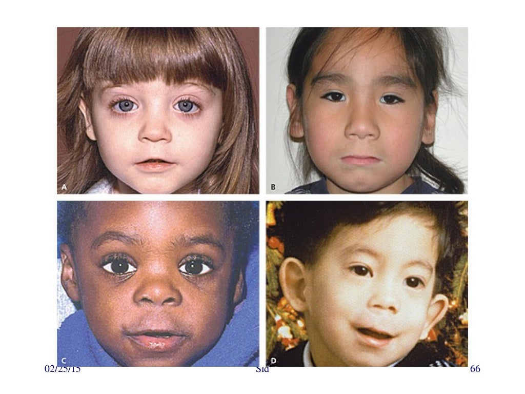 Approach to dysmorphic child