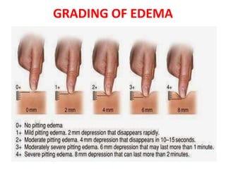 approach to edema.pptx