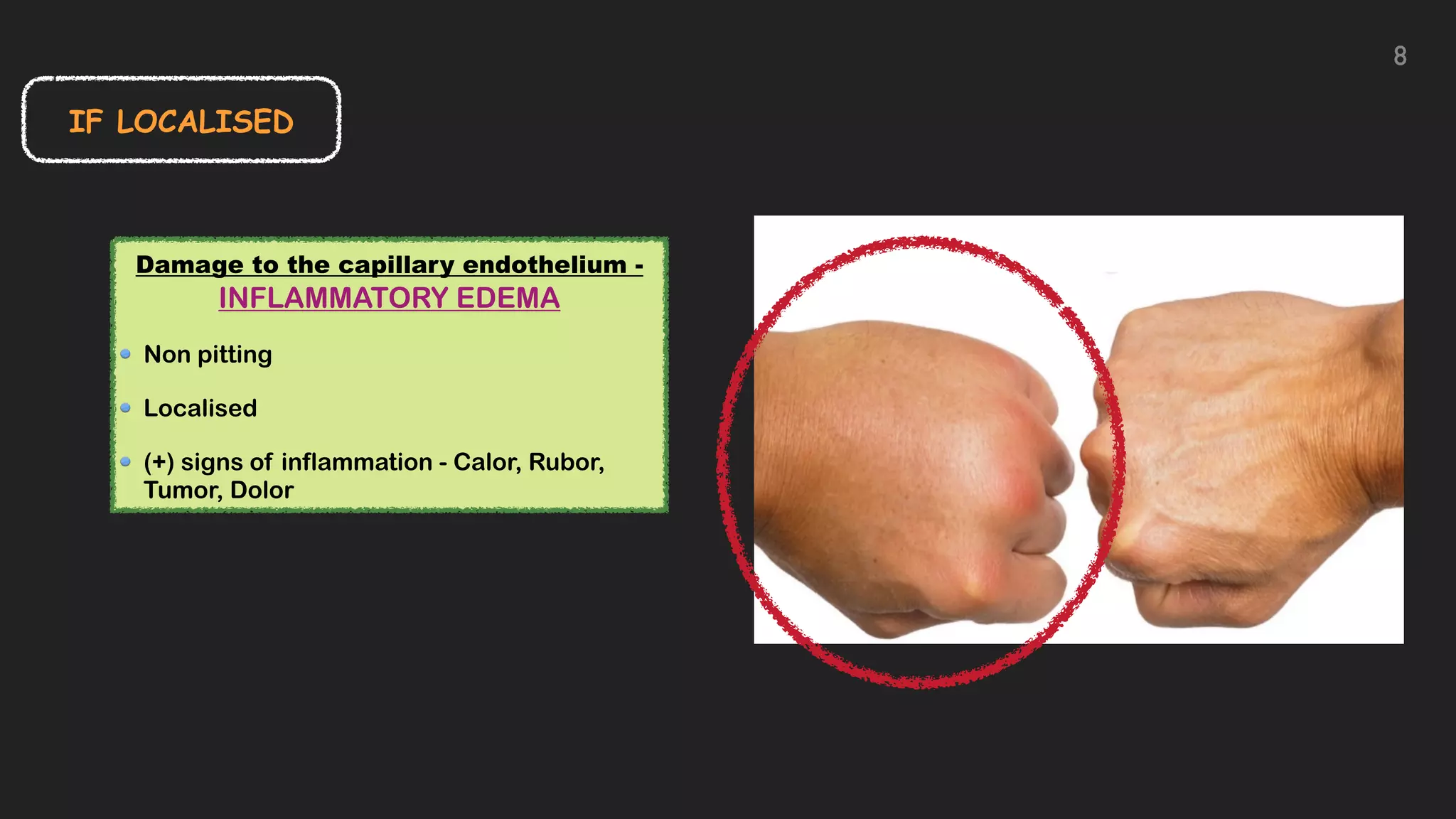 IF LOCALISED
Damage to the capillary endothelium -
INFLAMMATORY EDEMA


Non pitting


Localised


(+) signs of inflammation - Calor, Rubor,
Tumor, Dolor
8
 