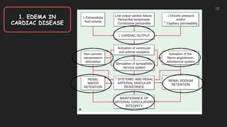 10
1. EDEMA IN
CARDIAC DISEASE
 