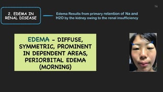 2. EDEMA IN
RENAL DISEASE
Edema Results from primary retention of Na and
H2O by the kidney owing to the renal insufficiency
14
EDEMA - DIFFUSE,
SYMMETRIC, PROMINENT
IN DEPENDENT AREAS,
PERIORBITAL EDEMA
(MORNING)
 