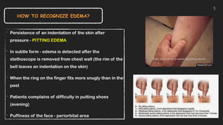 ‣ Persistence of an indentation of the skin after
pressure - PITTING EDEMA


‣ In subtle form - edema is detected after the
stethoscope is removed from chest wall (the rim of the
bell leaves an indentation on the skin)


‣ When the ring on the finger fits more snugly than in the
past


‣ Patients complains of difficulty in putting shoes
(evening)


‣ Puffiness of the face - periorbital area
HOW TO RECOGNIZE EDEMA?
5
 