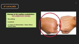 IF LOCALISED
Damage to the capillary endothelium -
INFLAMMATORY EDEMA


Non pitting


Localised


(+) signs of inflammation - Calor, Rubor,
Tumor, Dolor
8
 