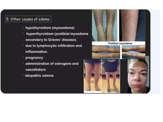 Led Edema Approach APPROACH TO EDEMA ppt.MANAGEMENT IN PATIENT | PPTX