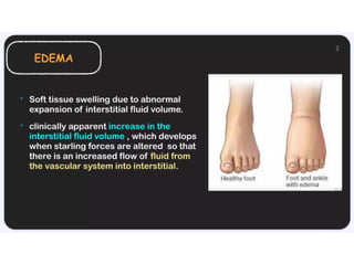 APPROACH TO EDEMA ppt.MANAGEMENT IN PATIENT | PPTX
