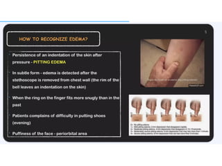 Led Edema Approach APPROACH TO EDEMA ppt.MANAGEMENT IN PATIENT | PPTX