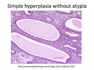 Complex hyperplasia without atypia
http://www.webpathology.com/image.asp?n=1&Case=568
 
