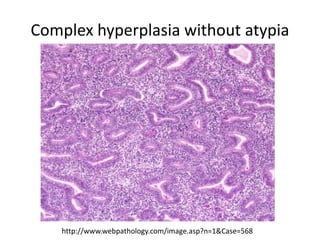 Complex hyperplasia without atypia
 