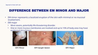 Patch Minor Emajor Approach to fever with rash in pediatrics.pptx