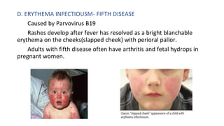 APPROACH TO FEVER WITH RASHES.pptx