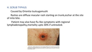 Diffuse Trunk Rash APPROACH TO FEVER WITH RASHES.pptx