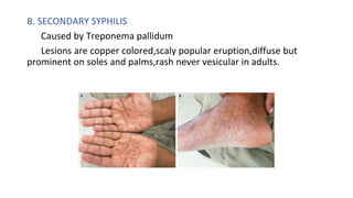 APPROACH TO FEVER WITH RASHES.pptx