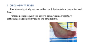 Pyrexia With Rash APPROACH TO FEVER WITH RASHES.pptx