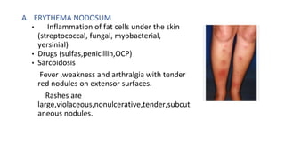 Violaceuous Rash APPROACH TO FEVER WITH RASHES.pptx