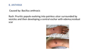 Pyrexia With Rash APPROACH TO FEVER WITH RASHES.pptx