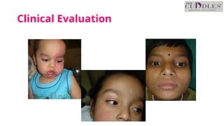 Unprovoked Approach to First episode of Unprovoked seizures in children .pptx