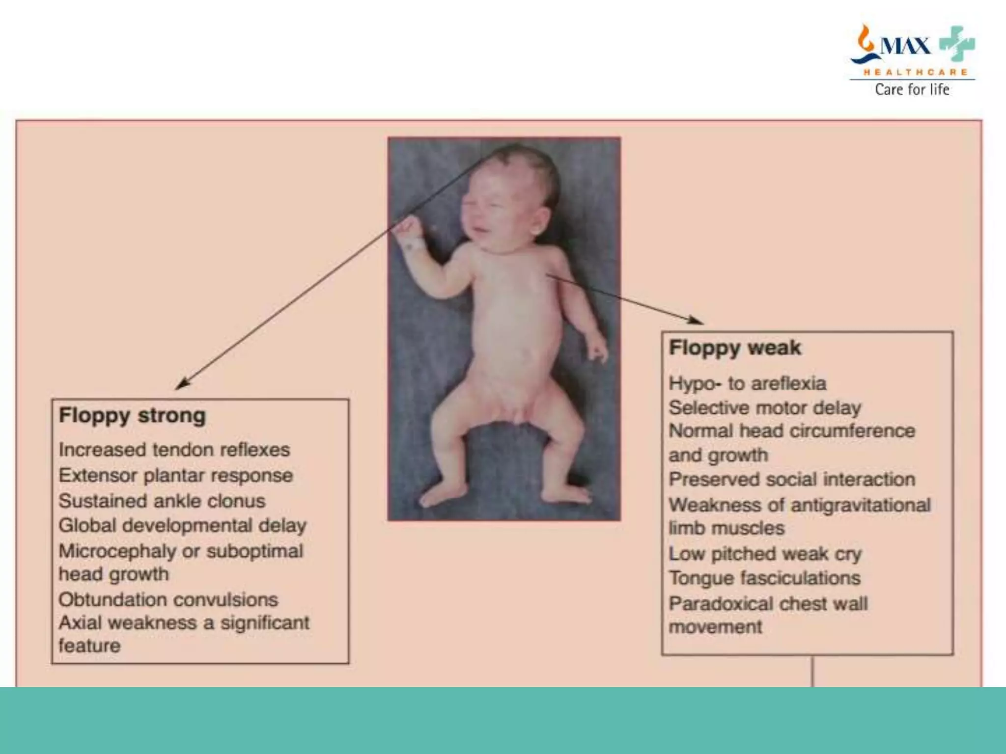 Approach to floppy infant | PPTX